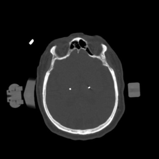 1.25mm Deep Brain Stimulation Bone Window 2 Electrodes-2